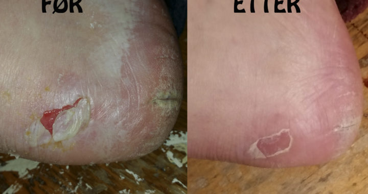 Gnagsår før og etter laserbehandling